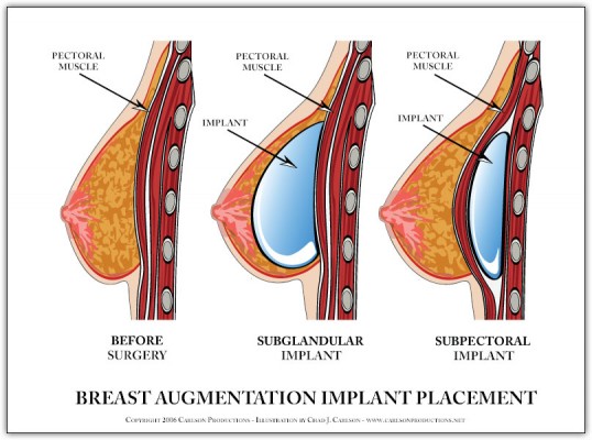 Breast Reconstruction in Toronto